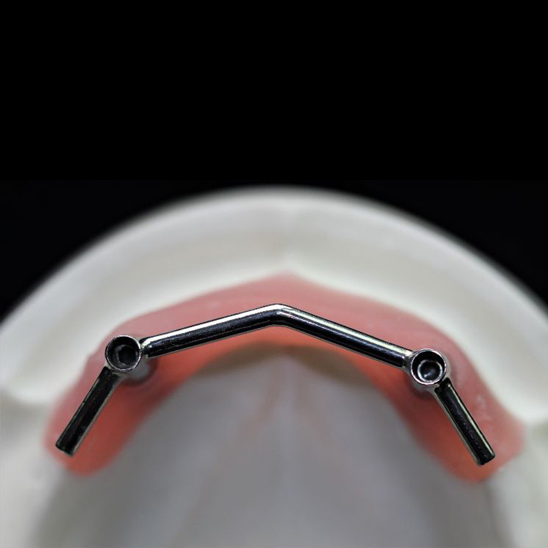 Bara de implant
