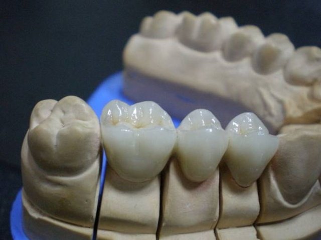 Restaurare fixă ​​Lucrare tradițională dentară de la început până la sfârșit în coroana și podul de laborator dentar