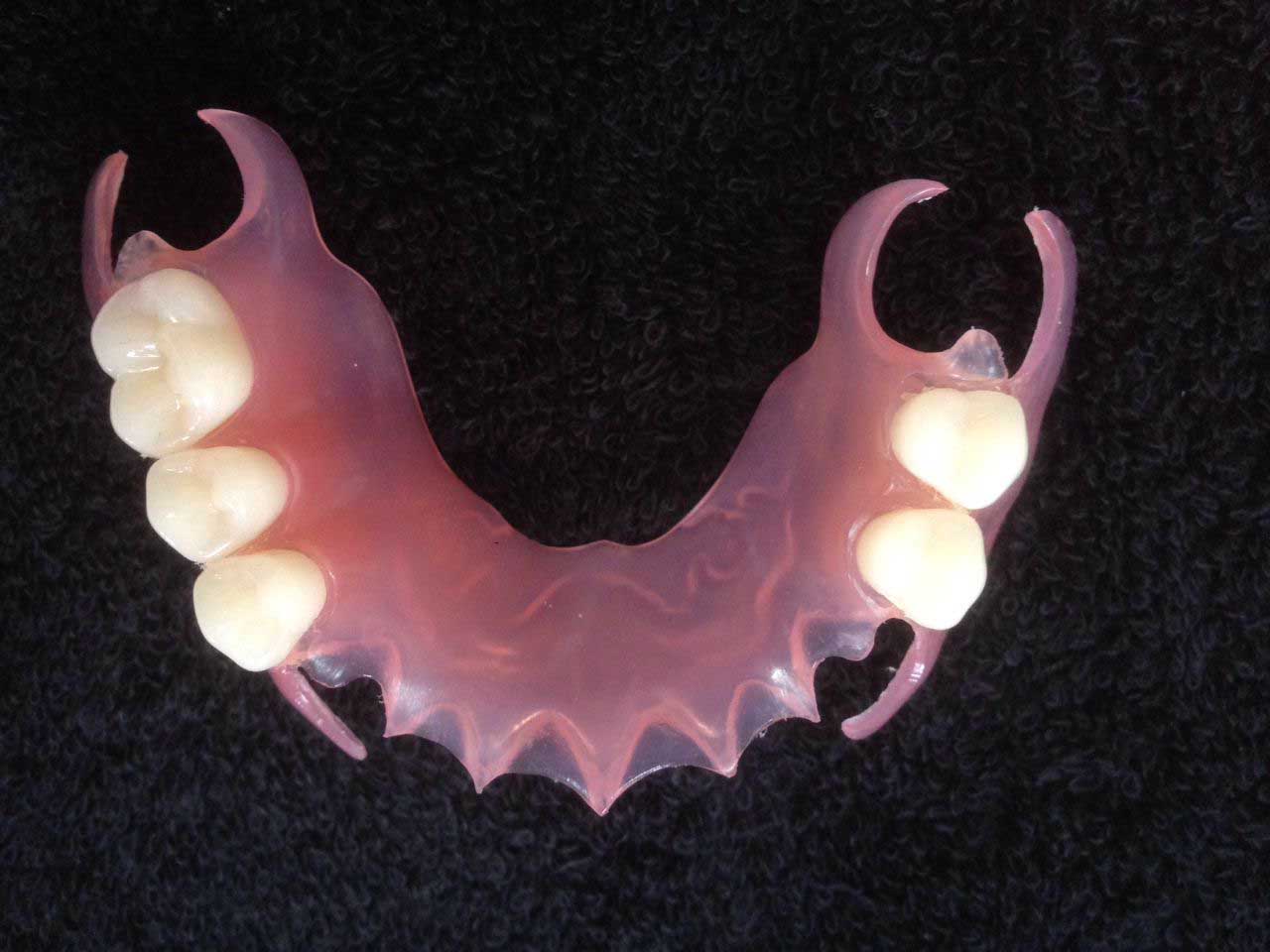 Proteză parțială Dinți acrilici dentare în stomatologie Rapid și ușor