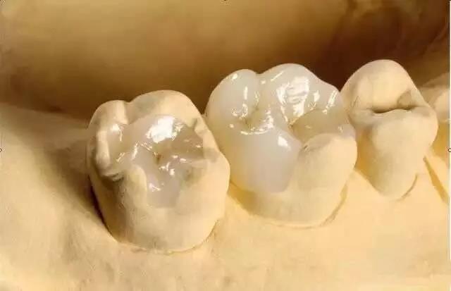 Incrustație dentară din zirconiu pentru salvarea defectelor de suprafață mică ale dintelui natural
