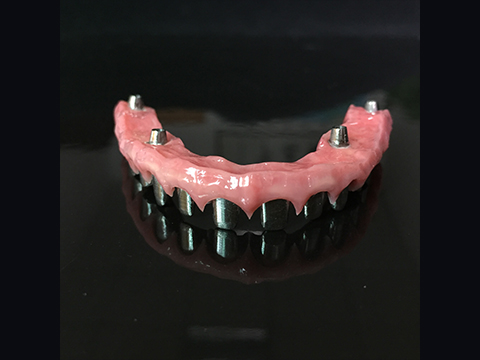 Ce ar trebui să facem după un implant dentar?