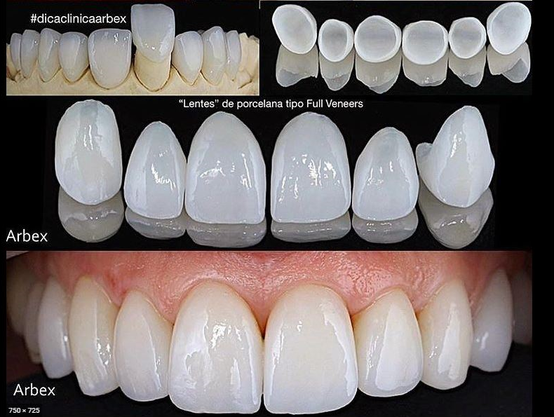 Ce alimente nu ar trebui să mănânc după operația dentară?
