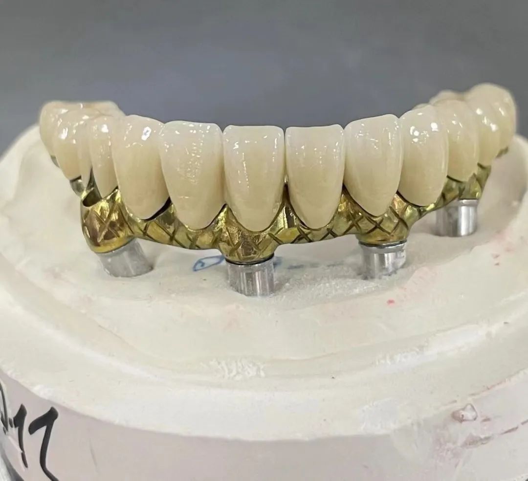 Diferențele dintre bara de implant și puntea Malong