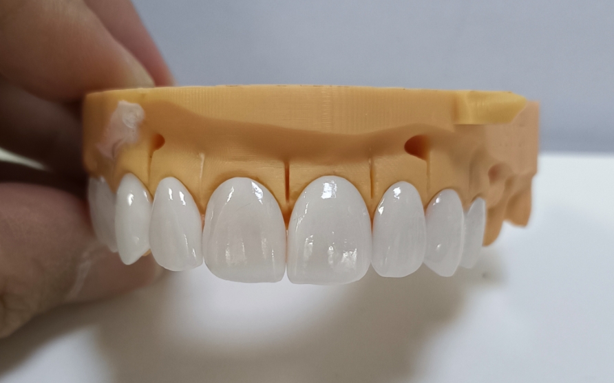 Fațete Emax de înaltă estetică