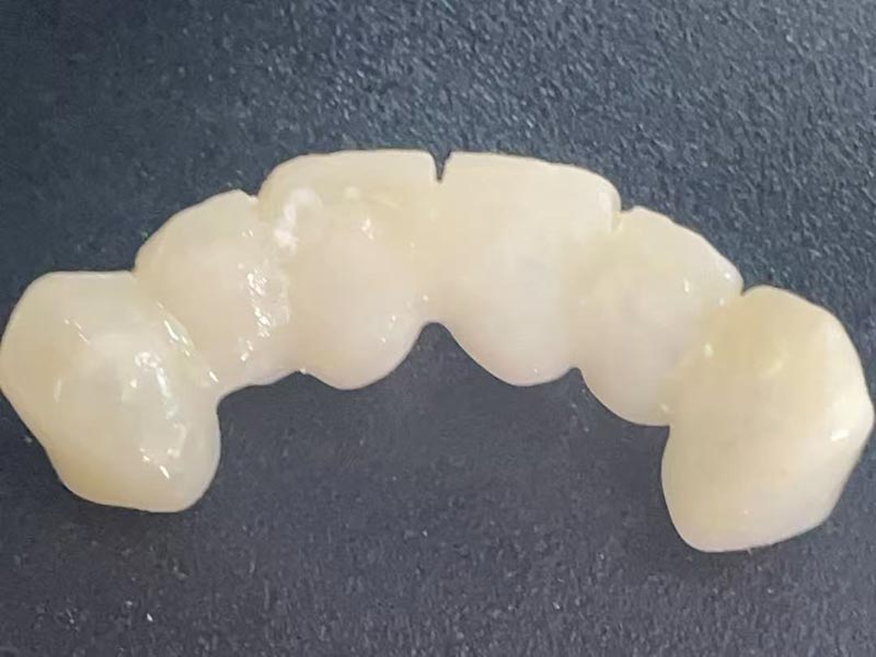 Ce este o „Coroană temporară”? De ce ai nevoie de unul?