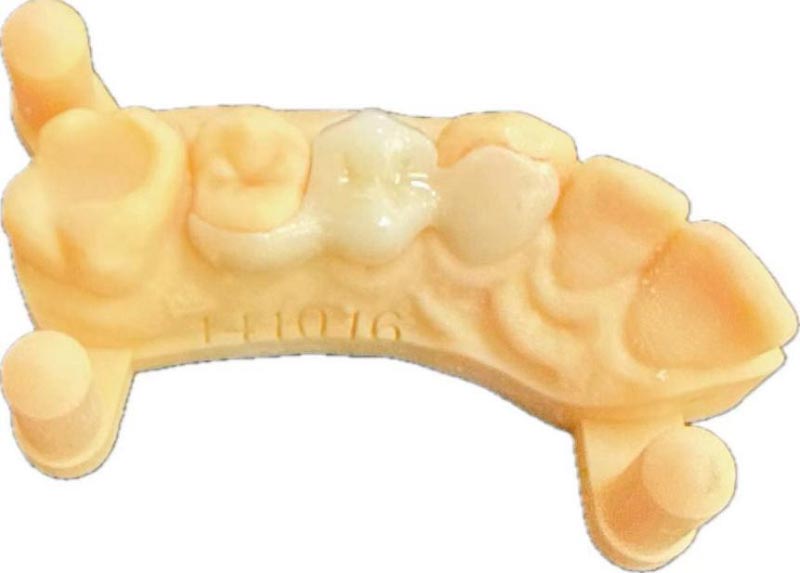 Ce să faci după extracția dentară?
