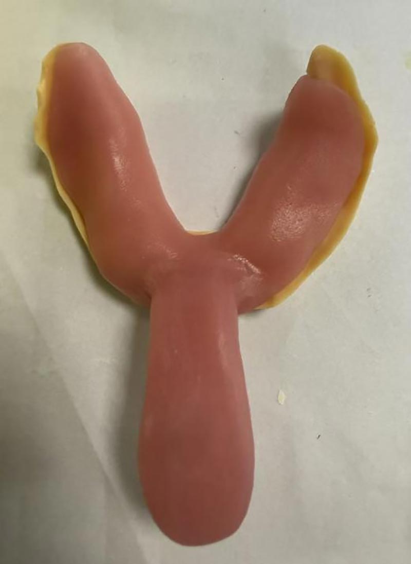 Lucruri pe care nu le știați despre tăvile dentare personalizate