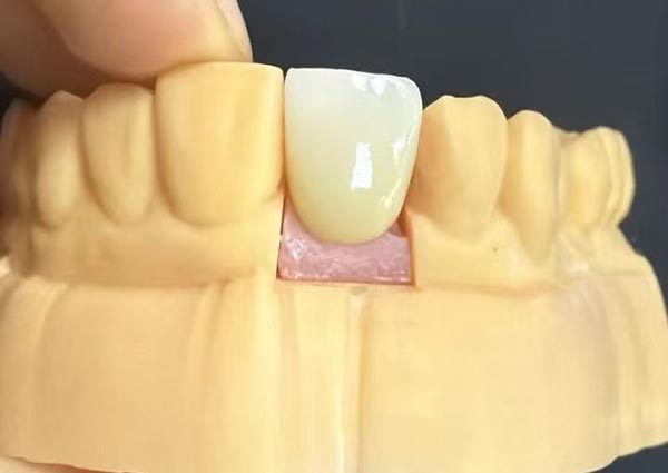 Dispozițiile dintre dinți pot fi remediate — dinții drepți sunt cei mai atractivi!