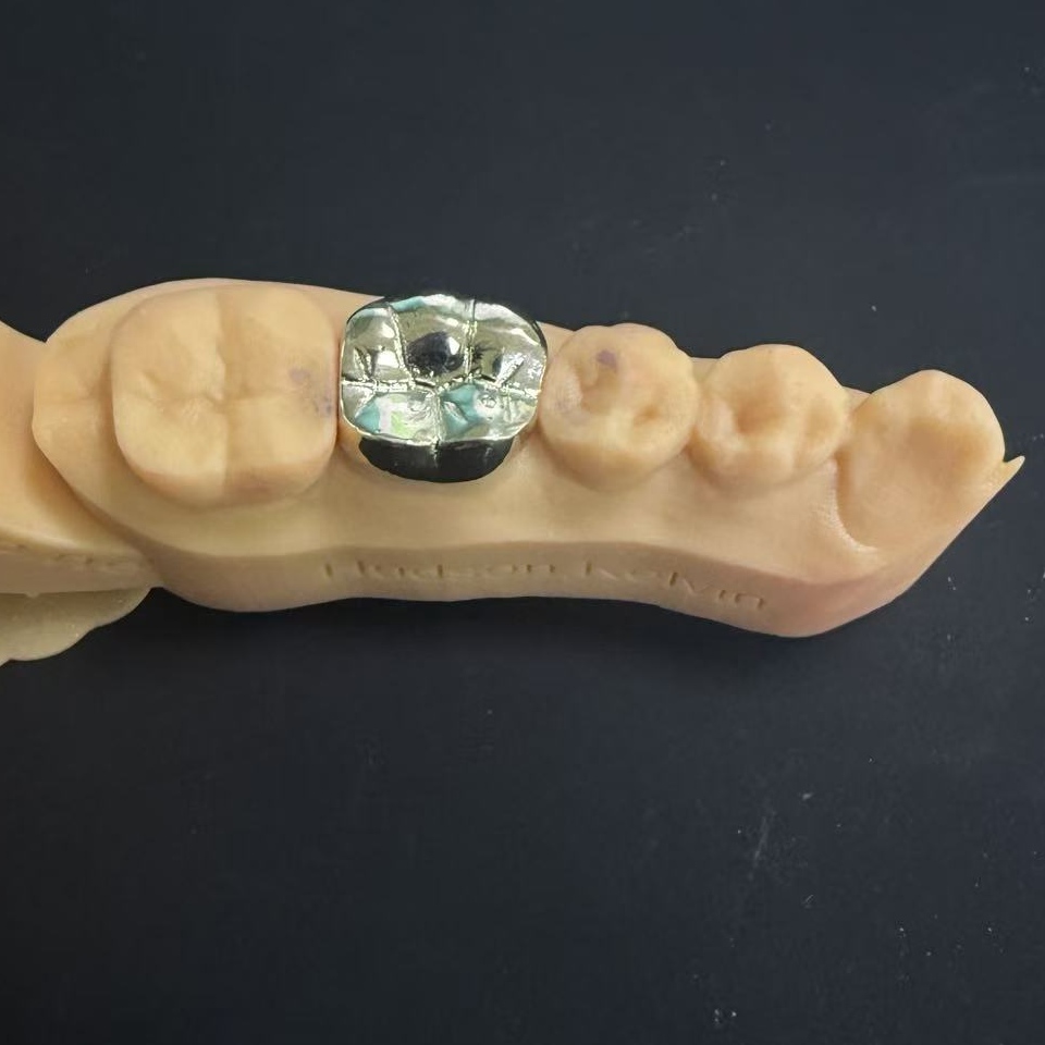 Coroane de aur: alegerea metalelor prețioase pentru restaurarea dentară pe tot parcursul vieții