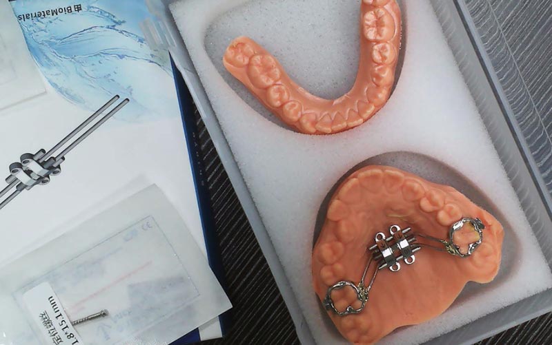 Înțelegeți MSE Skeletal Expansion cu WM Dental Lab