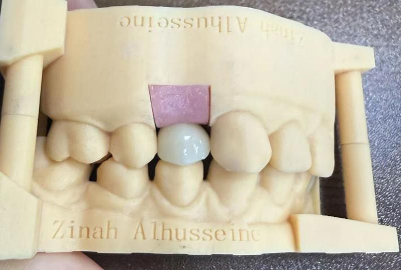 Siguranța și precauțiile implanturilor dentare