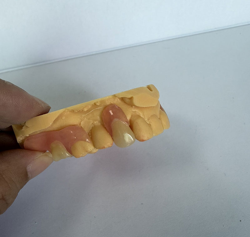 Valplast Partials la WM Dental Lab