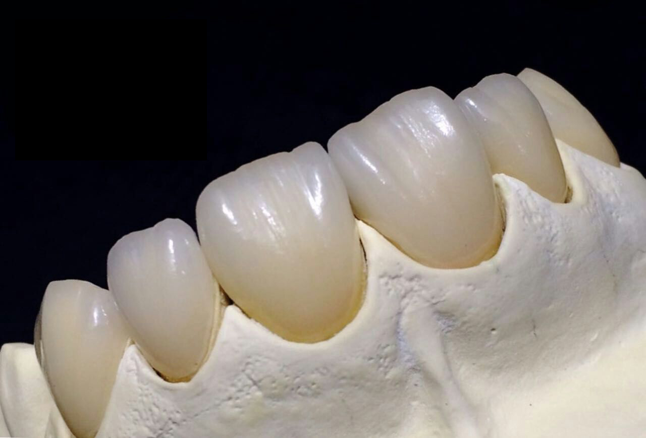 Coroana integrala din ceramica