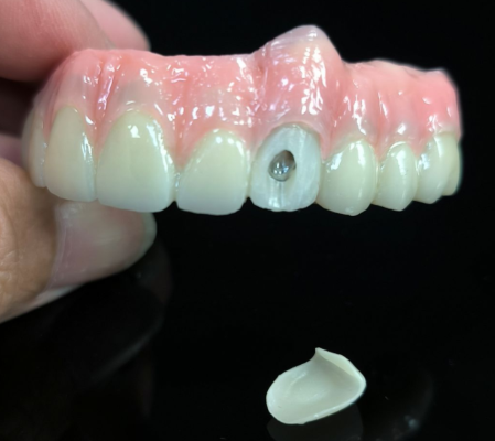 Toate pe 4 Hybrid - Hybrid Zirconia Bridge Solution pentru gaura șurubului vestibular