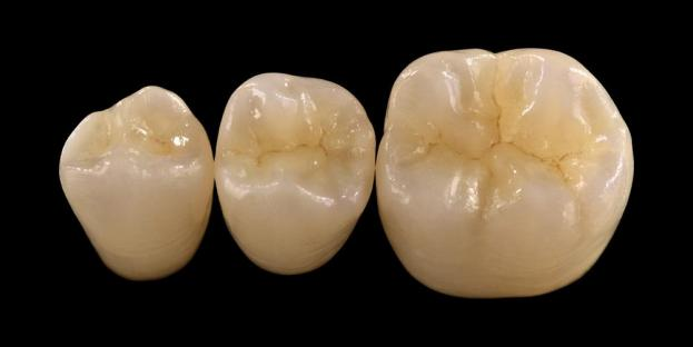 <h2>Zirconia în stomatologie: indicații, avantaje și considerații clinice</h2>
<p>Zirconia este recunoscută pe scară largă pentru rezistența și durabilitatea sa. Cele mai recente generații de materiale din zirconiu oferă, de asemenea, proprietăți estetice semnificativ îmbunătățite. Pentru pacienții care iau în considerare restaurări din ceramică integrală, este esențial să se evalueze cu atenție atât indicațiile, cât și limitările sistemelor pe bază de zirconiu.</p>
<p>Pacienții de astăzi se așteaptă din ce în ce mai mult la restaurări care combină o estetică excelentă cu o performanță funcțională completă. Majoritatea sistemelor ceramice moderne pot satisface aceste așteptări, dar succesul clinic depinde în mare măsură de selecția adecvată a materialului, pregătirea dinților și protocoalele de cimentare. Alegerea ar trebui să fie ghidată de proprietățile cheie ale materialului, cum ar fi rezistența la rupere, rezistența la încovoiere, rezistența la uzură și stabilitatea pe termen lung. Dintre aceste materiale, zirconia a devenit una dintre cele mai utilizate opțiuni în stomatologia restaurativă contemporană.</p>
<h3>De ce să alegeți Zirconia?</h3>
<p>Zirconia este apreciată pentru rezistența sa excepțională și durabilitatea pe termen lung. Zirconia modernă este semnificativ diferită de generațiile anterioare, care erau mai opace și mai puțin estetice. Astăzi, tehnologia CAD/CAM permite fabricarea precisă a restaurărilor din zirconiu cu proprietăți optice îmbunătățite.</p>
<p>Restaurarile pot fi proiectate ca:</p>
<ul>
<li><strong>Zirconiu monolitic:</strong>Ideal pentru coroane și punți posterioare, oferind rezistență și durabilitate ridicate.</li>
<li><strong>Zirconiu stratificat:</strong>Potrivit pentru cazurile care necesită o estetică îmbunătățită, inclusiv restaurări de lungă durată în diferite zone ale gurii.</li>
</ul>
<p>Rezistența la încovoiere variază în funcție de tip, variind de la aproximativ 590 MPa în zirconiu cu transluciditate ridicată până la 1400 MPa în forme monolitice. Restaurarile din zirconiu pot fi cimentate folosind cimenturi rasinoase autoadezive sau cimenturi cu ionomer de sticla modificate cu rasina.</p>
<h3>Factori cheie în selecția materialului cu zirconiu</h3>
<p>Când iau în considerare zirconia pentru o restaurare din ceramică integrală, clinicienii ar trebui să evalueze câțiva factori critici:</p>
<ul>
<li>Structura dentară rămasă</li>
<li>Localizare în cavitatea bucală (zonă estetică vs zonă funcțională)</li>
<li>Prezența unor obiceiuri parafuncționale precum bruxismul</li>
<li>Transluciditatea dinților naturali adiacenți</li>
<li>Culoarea și starea structurii dentare subiacente</li>
</ul>
<p>Zona estetică include de obicei dinții anteriori, deși la unii pacienți se poate extinde până la primul molar în funcție de linia zâmbetului și dinamica facială. Zona funcțională include în general premolari și molari, unde forțele ocluzale sunt semnificativ mai mari.</p>
<h3>Aplicații de zonă funcțională</h3>
<p>În regiunile posterioare, forțele ocluzale trebuie luate în considerare cu atenție. Zirconia este o alternativă excelentă la restaurările tradiționale PFM, mai ales în cazurile cu spațiu de restaurare limitat. Zirconia monolitică modernă permite proiectarea cu contur complet al anatomiei ocluzale, inclusiv cuspizii funcționali și crestele marginale, menținând în același timp rezistența ridicată.</p>
<p>Dovezile actuale arată că zirconia monolitică este foarte potrivită pentru coroanele posterioare și punțile cu mai multe unități datorită rezistenței sale excelente la rupere și uzură. Progresele în tehnicile adezive și designul preparatelor au îmbunătățit, de asemenea, rezultatele clinice pe termen lung.</p>
<h3>Aplicații în zona estetică</h3>
<p>În regiunea anterioară, restaurările trebuie să reproducă îndeaproape culoarea dintelui natural, transluciditatea și comportamentul la lumină. În timp ce materiale precum disilicatul de litiu oferă o estetică excelentă, ele sunt mai puțin puternice și necesită de obicei lipire adeziv.</p>
<p>Un avantaj cheie al zirconiei este capacitatea sa de a fi cimentat în mod convențional, obținând totuși performanțe estetice ridicate. Odată cu dezvoltarea sistemelor de zirconiu cu transluciditate ridicată și multistrat, acum este posibil să se producă restaurări care imită îndeaproape dentiția naturală.</p>
<p>Tehnicile avansate de procesare îmbunătățesc și mai mult proprietățile optice și reduc imperfecțiunile care pot afecta transmisia și aspectul luminii.</p>
<h3>Forță și estetică combinate</h3>
<p>Sistemele timpurii din zirconiu au prioritizat rezistența, dar nu aveau calitatea estetică. Zirconia monolitică modernă combină cu succes atât rezistența, cât și aspectul îmbunătățit, făcându-l potrivit pentru o gamă largă de cazuri clinice.</p>
<p>Este deosebit de benefic pentru pacienții cu obiceiuri parafuncționale sau eșecuri anterioare de restaurare. Studiile clinice indică o acceptare ridicată a pacientului și rate scăzute de complicații.</p>
<p>Preocupările cu privire la uzura dentiției opuse au fost reduse cu formulări mai noi. Suprafețele din zirconiu foarte lustruite demonstrează un potențial abraziv scăzut și, în unele cazuri, pot fi mai blânde decât restaurările tradiționale din porțelan topit pe metal.</p>
<h3>Implanturi de zirconiu: alternativă emergentă</h3>
<p>În timp ce implanturile de titan rămân standardul clinic, implanturile de zirconiu câștigă atenția ca alternativă fără metale. Proiectele timpurii au fost în primul rând sisteme dintr-o singură piesă, dar implanturile din zirconiu din două piese permit acum o flexibilitate protetică îmbunătățită.</p>
<p>Implanturile de zirconiu sunt deosebit de utile în cazurile în care există probleme estetice, cum ar fi potențiala decolorare gri a țesuturilor periimplantare sau biotipul gingival subțire. Ele pot fi luate în considerare și pentru pacienții cu sensibilitate rară la titan.</p>
<p>Cu toate acestea, implanturile de zirconiu sunt încă relativ noi, iar datele clinice pe termen lung rămân limitate în comparație cu sistemele din titan.</p>
<h3>Concluzie</h3>
<p>Zirconia a evoluat într-un material extrem de versatil în stomatologia restaurativă, oferind un echilibru puternic între performanța mecanică și estetică. Selectarea corectă a cazurilor și respectarea protocoalelor clinice sunt esențiale pentru obținerea unor rezultate optime atât în ​​aplicațiile anterioare cât și posterioare.</p>
